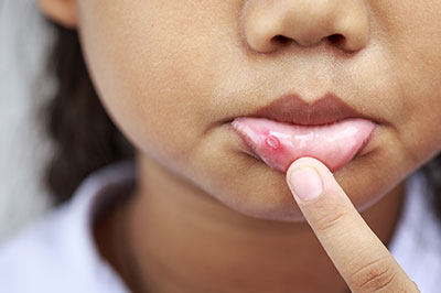 A close-up of a child's hand holding a finger near their mouth, showing a small red spot on the skin.